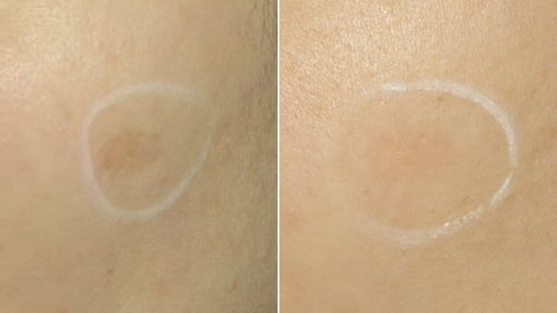 흑자 레이저 치료 전후
