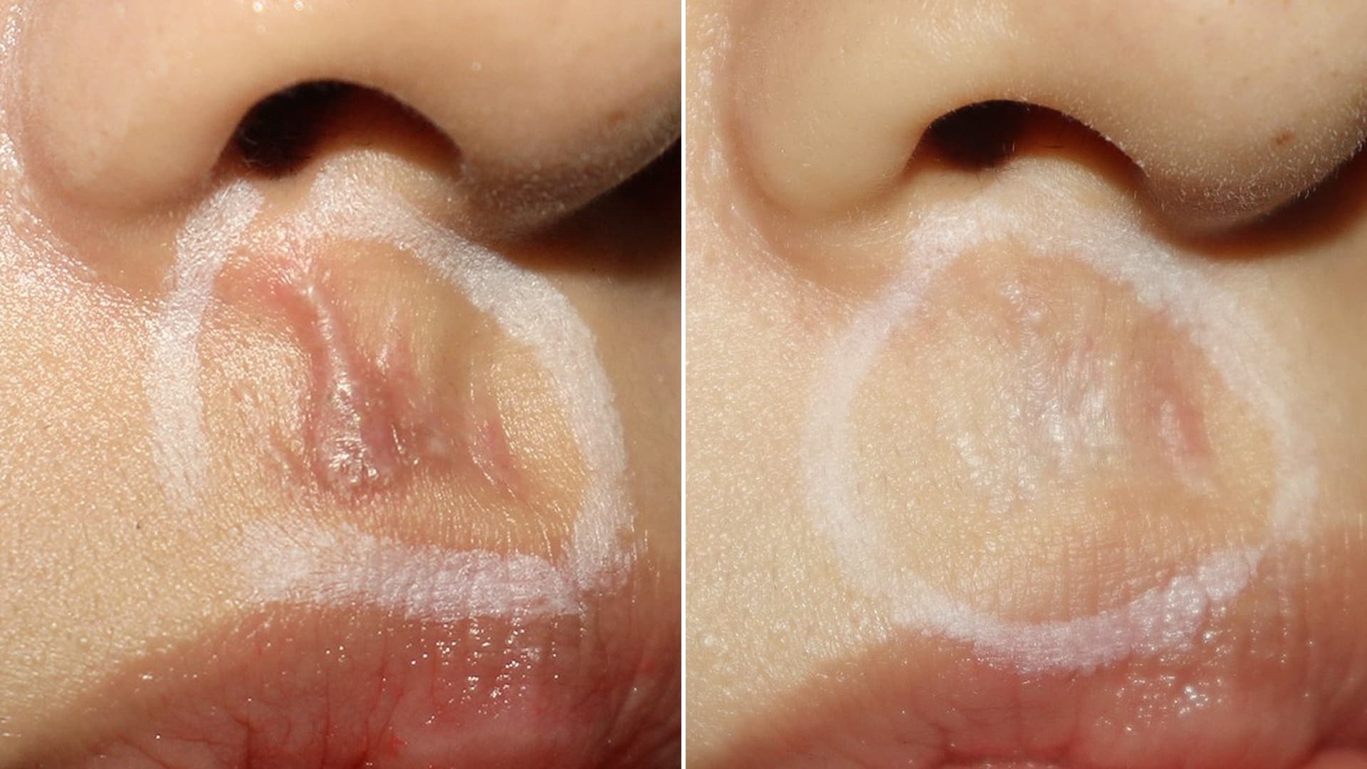 인중 켈로이드 치료 전후
