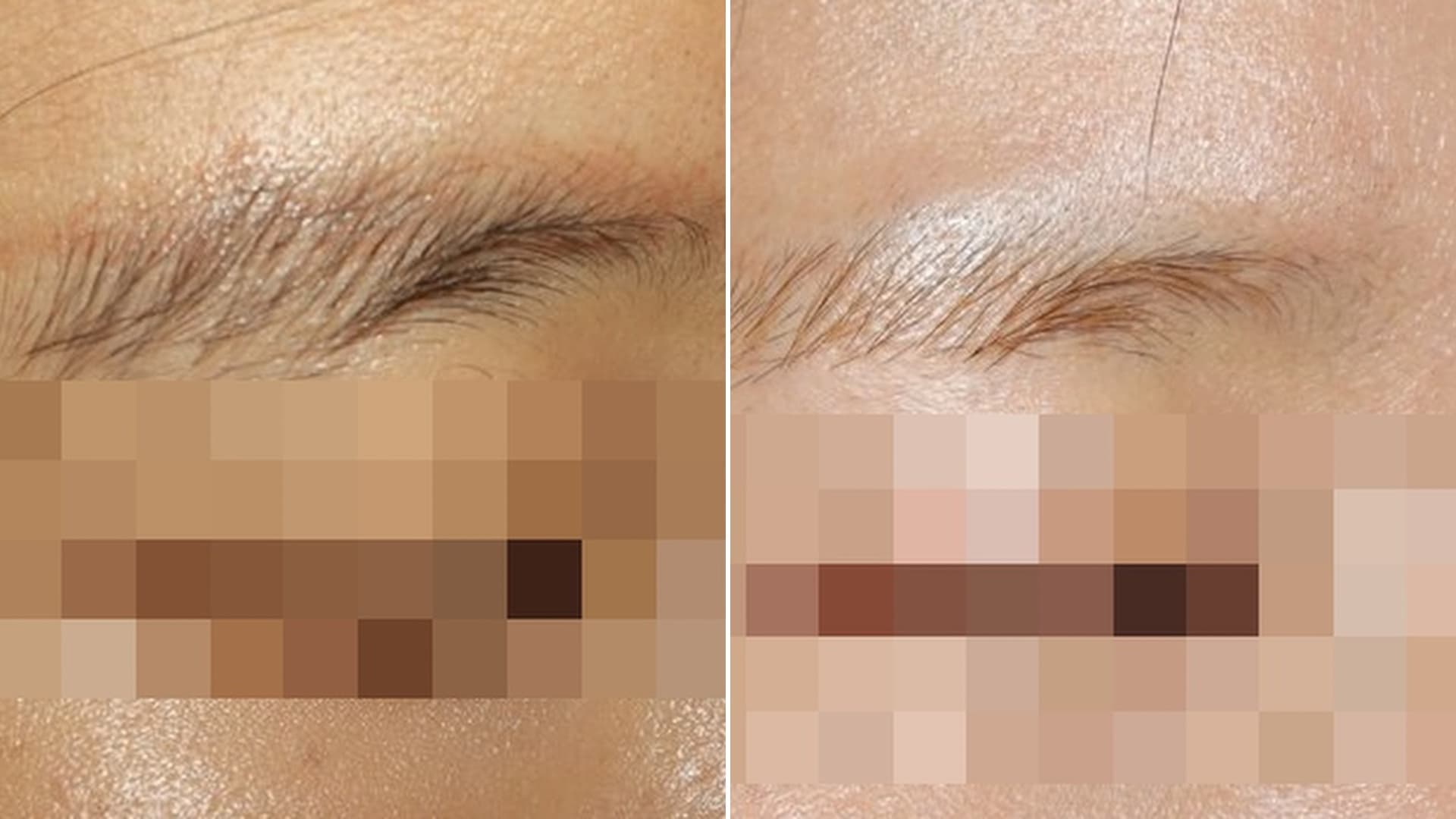 반영구(눈썹) 문신제거 전후
