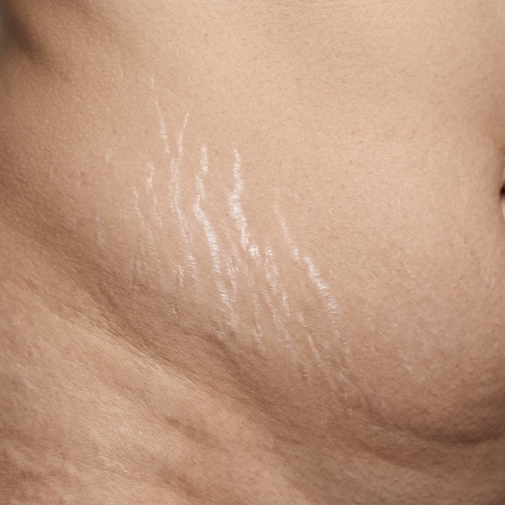 오래된 하얀 튼살이 신경 쓰이는 분