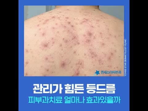 등여드름과 여드름 압출, 피부과에서 관리해야 하는 이유