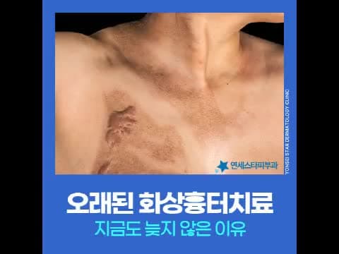 오래된 화상흉터, 지금 시작하는 레이저 치료의 방향