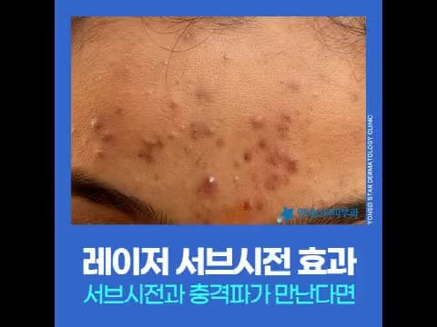 패인 여드름 흉터에 서브시전과 충격파 레이저를 함께 쓸 때