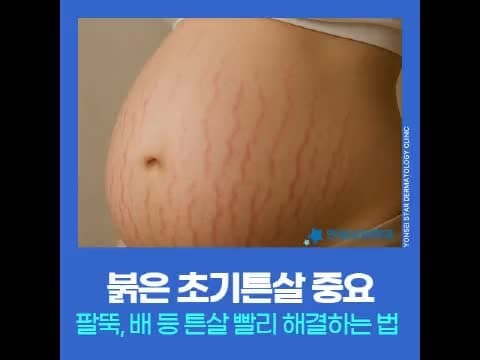붉은튼살이 골든타임인 이유와 팔뚝 허벅지 배 튼살 레이저 치료