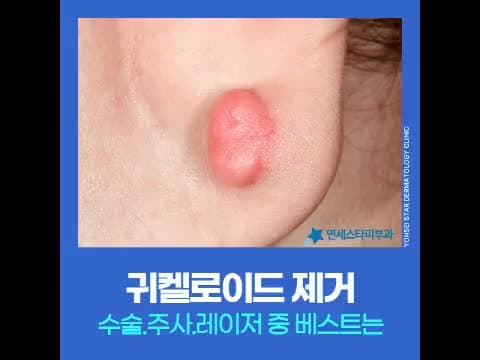 귀켈로이드, 주사와 레이저 치료 그리고 재발 관리