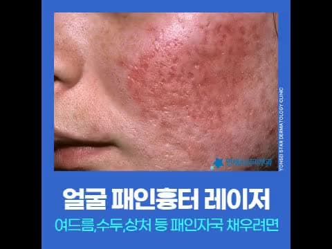 얼굴 패인 흉터, 재생레이저와 서브시전을 함께 접근하는 이유