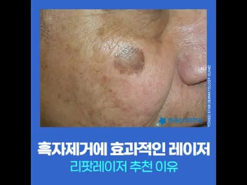 흑자 색소를 초기에 접근해야 하는 이유와 리팟레이저