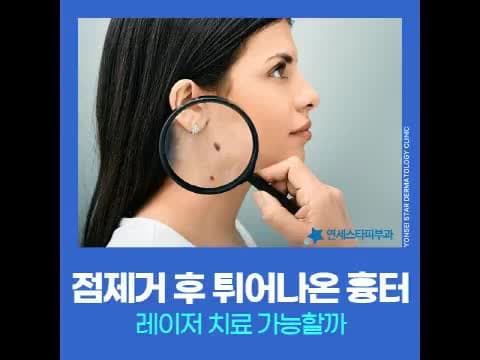 점뺀흉터, 점제거 후 튀어나온 흉터 레이저 치료 가능할까