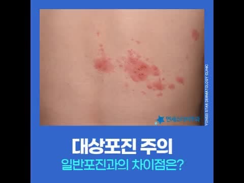 대상포진 증상 일반포진차이 치료를 미루면 안되는 이유 | 연세스타피부과 신촌본점