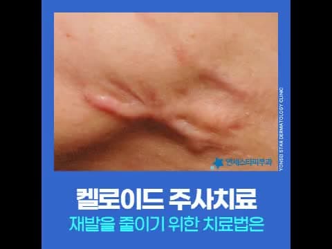 켈로이드주사 효과있을까? 재발줄이는 흉터 치료 관리 | 연세스타피부과 신촌