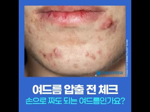 여드름압출 가능한 상태는? 방학을 활용한 효과적인 여드름관리법 추천
