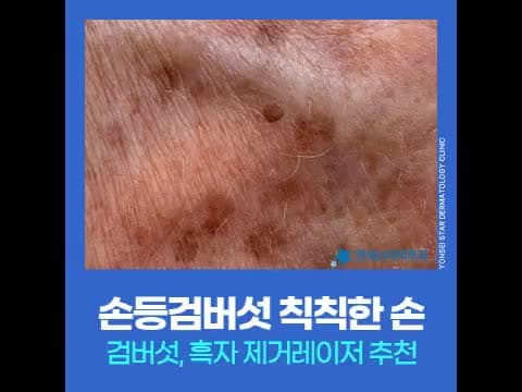 손등검버섯 치료 제거 레이저 추천 - 신촌 리팟레이저 및 관리법