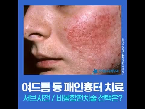 여드름흉터 시술 추천 비봉합펀치술 vs 서브시전 어떻게 활용될까