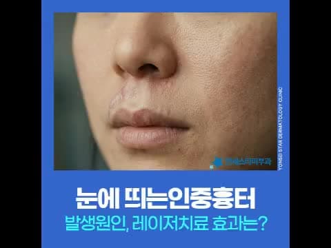 Philtrum and Lip Scar Laser Treatment