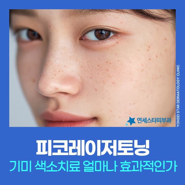 기미 레이저토닝 장비 차이가 있을까? 꾸준히 관리해야 하는 이유 | 신촌 연세스타피부과