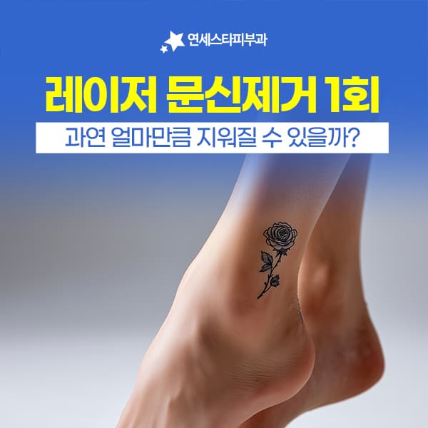 문신제거 1회로 끝낼 수 없을까? 문신제거횟수를 줄이는 현명한 방법 | 신촌 연세스타피부과