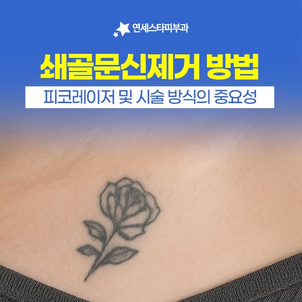 신촌 쇄골문신제거 레이저 방식 신중한 선택 필요 이유 | 연세스타피부과