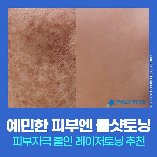 신촌 쿨샷토닝 주목 이유, 예민하고 얇은 피부 타입 레이저토닝 부담 줄이는 방법 | 연세스타피부과
