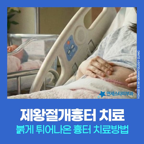 제왕절개수술흉터 제거 켈로이드 재발주의 복합 치료 권장 이유 | 연세스타피부과 신촌