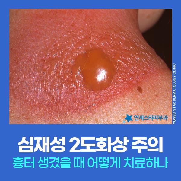 심재성 2도화상흉터 레이저효과, 흉터병원 어떻게 치료할까