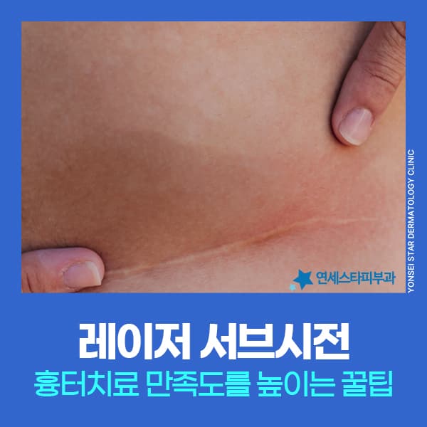 레이저서브시전, 예민한 피부도 패인흉터치료 받을 수 있을까 | 연세스타피부과 신촌