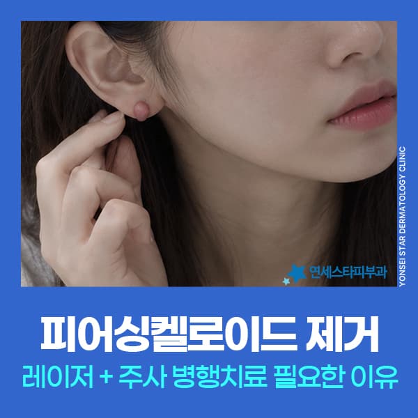 Piercing Ear Keloid Treatment: Combined Laser and Injection for Enhanced Effect