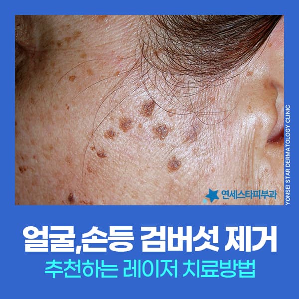 Seborrheic Keratosis Removal: Reepot Laser Effects and Treatment Methods at a Dermatology Clinic