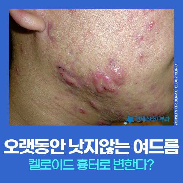 여드름켈로이드 켈로이드레이저 병행치료, 재발 예방 기대