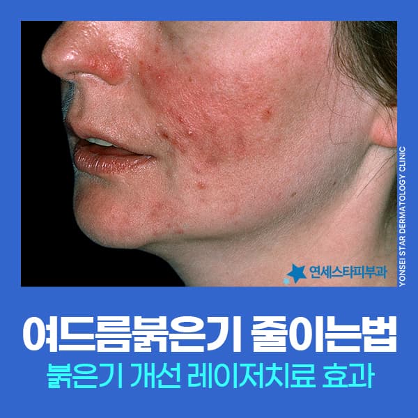 여드름 붉은자국 없애는 법, 브이빔 프리마 레이저 혈관 개선