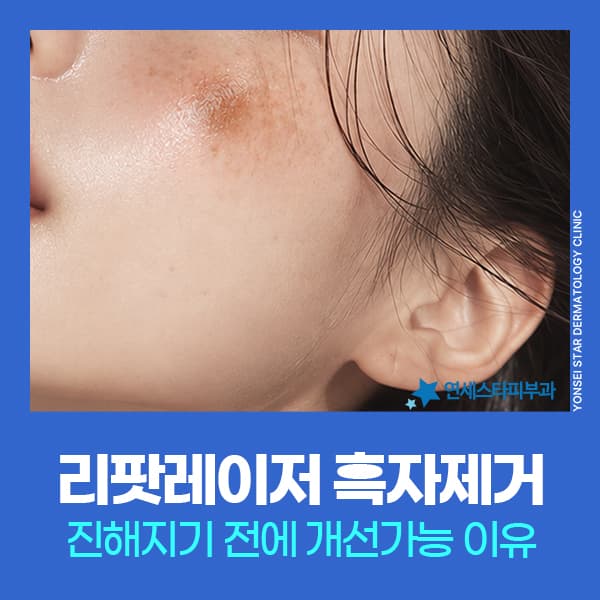 흑자 원인과 리팟레이저 색소 치료 체크리스트