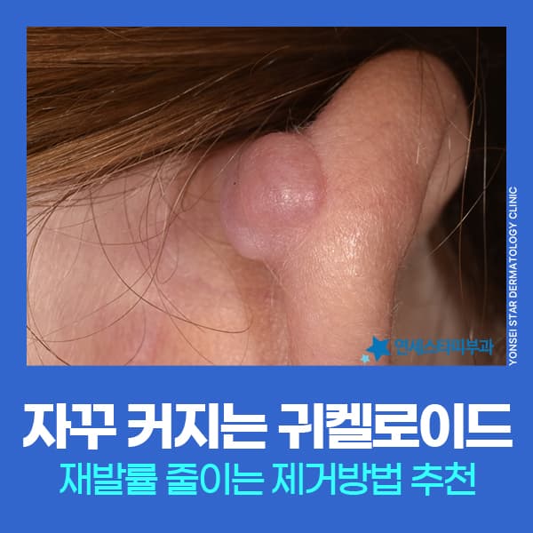 귀켈로이드통증 미루지말고 확인해야 하는 이유, 귀켈로이드제거 방법