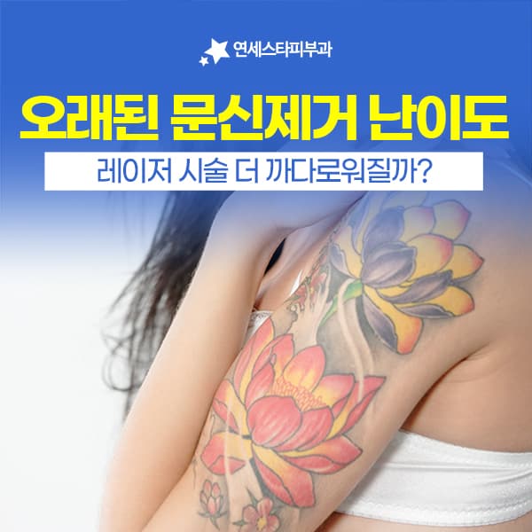 신촌 오래된문신제거, 문신제거레이저 기간과 알제로 방식