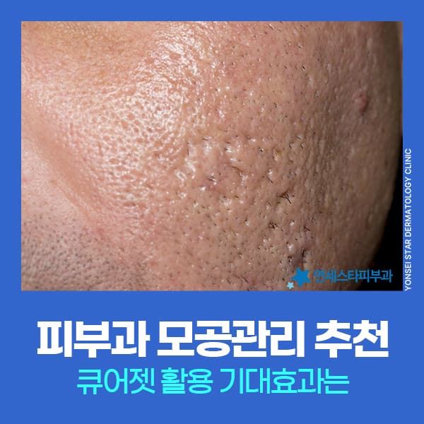 신촌 큐어젯 피부과모공관리와 스킨부스터
