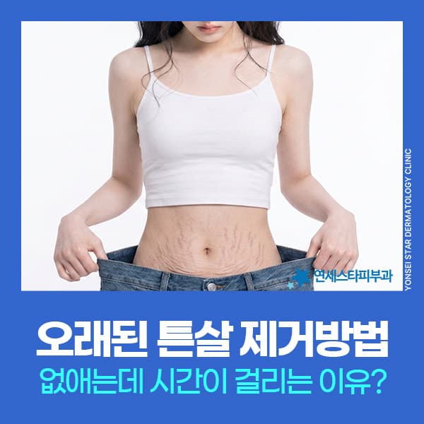 오래된튼살없애는법, 하얀 튼살 레이저와 핀홀법