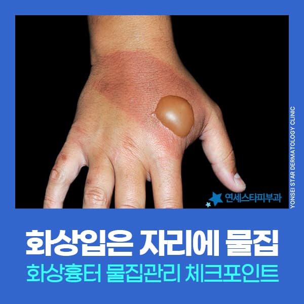 신촌 화상물집통증, 화상흉터물집 초기 관리