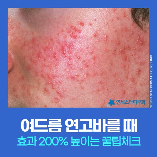 신촌 여드름연고 바르는법과 적정 사용량