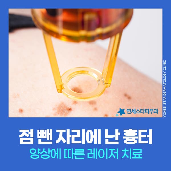 신촌 점뺀흉터제거, 얼굴점뺀흉터 유형별 치료