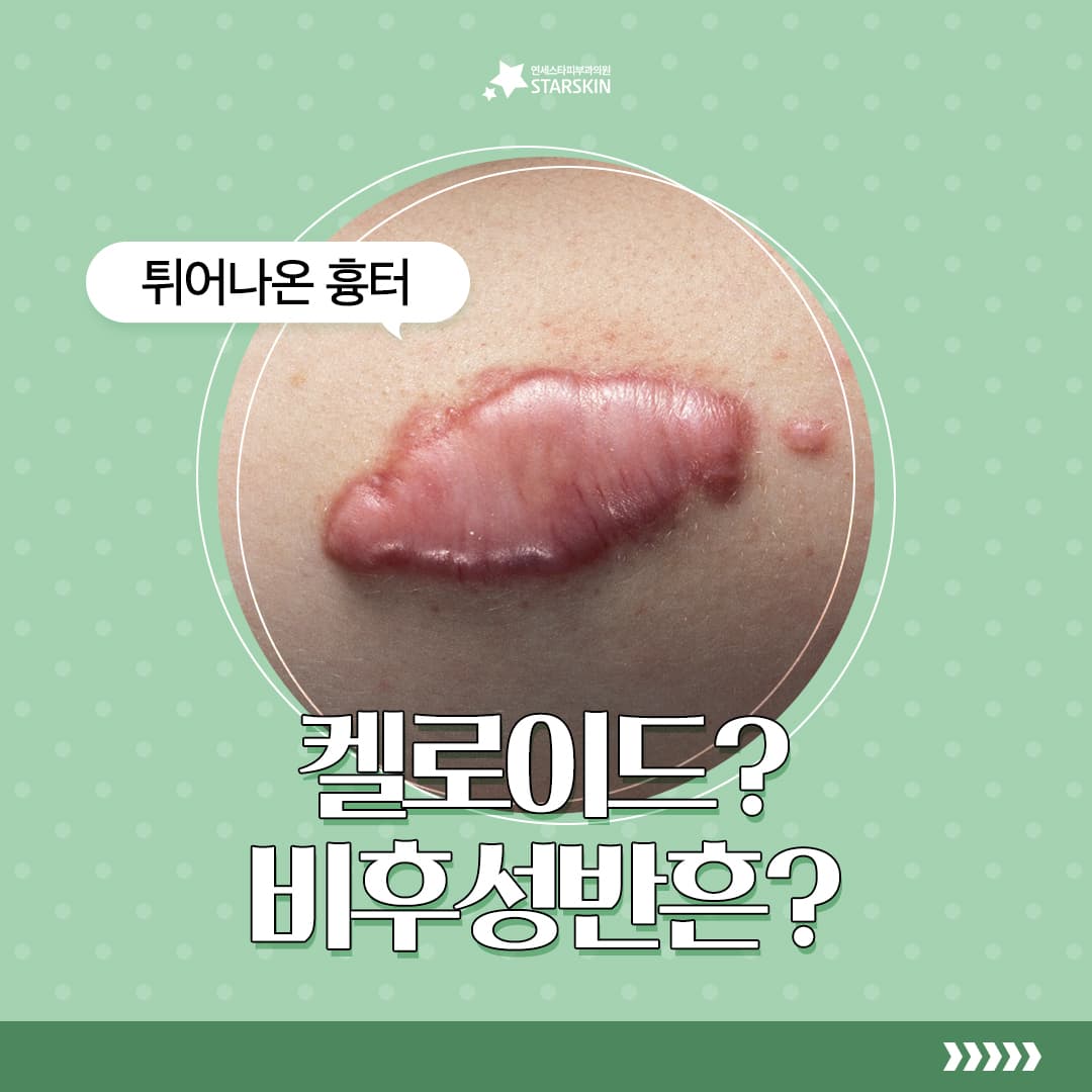 튀어나온 흉터 켈로이드?비후성반흔?🤷♀️