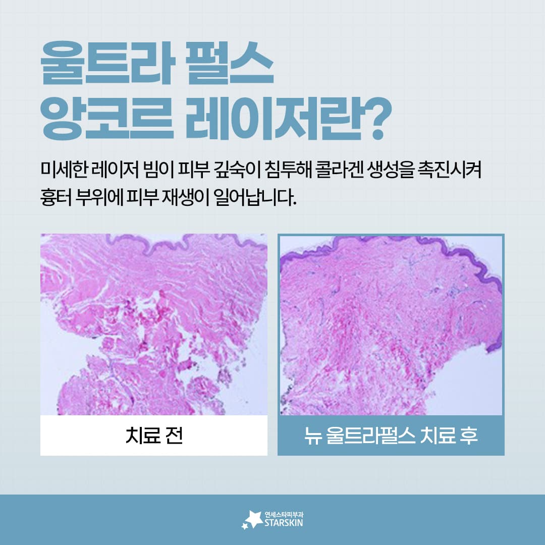 ➡️울트라펄스앙코르레이저란? (2023.12.19)