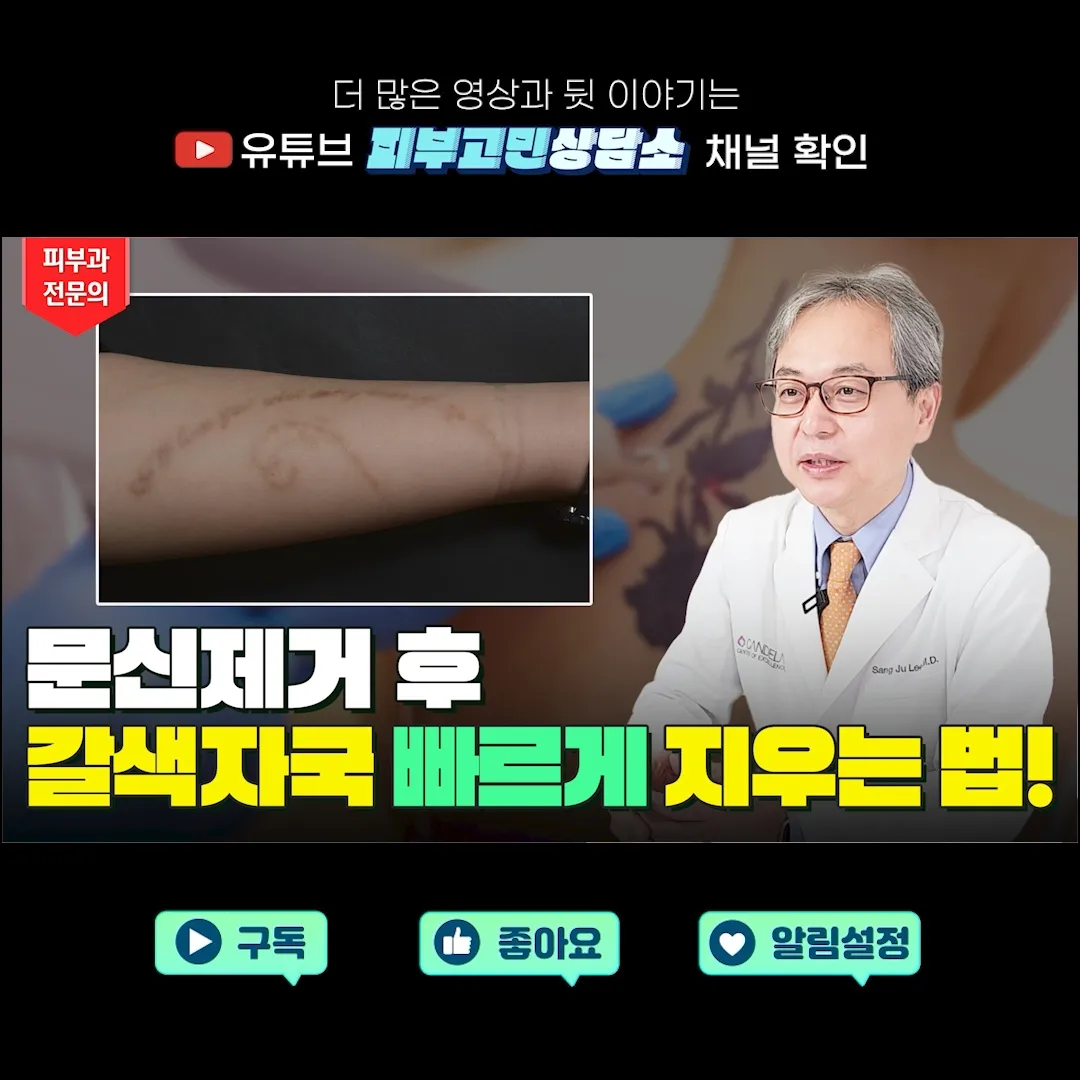 문신제거 갈색 자국 색소침착 🟤 빠르게 지우는 꿀팁 공개🍯 문신 깔끔하게 지우는 방법