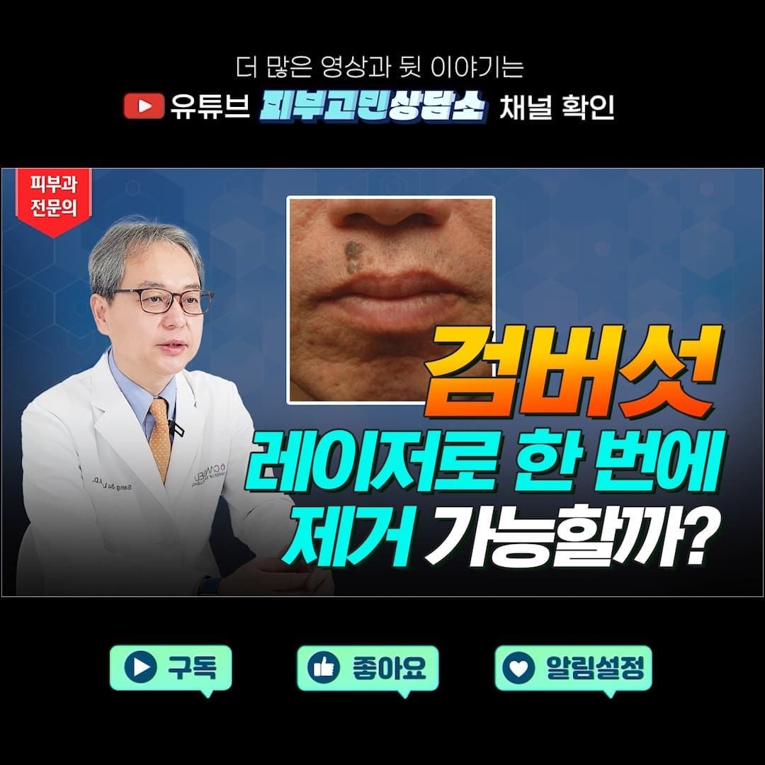 60代以上の高齢層に多く見られる脂漏性角化症(老人性イボ)‼