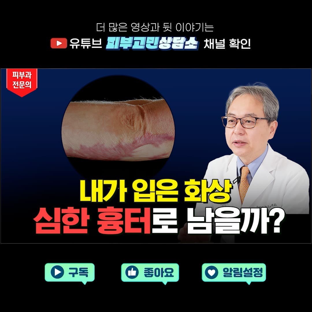 화상 입었을때 가장 많이 하는 질문은 바로 '제가 입은 화상이 흉터로 남을까요?'입니다‼