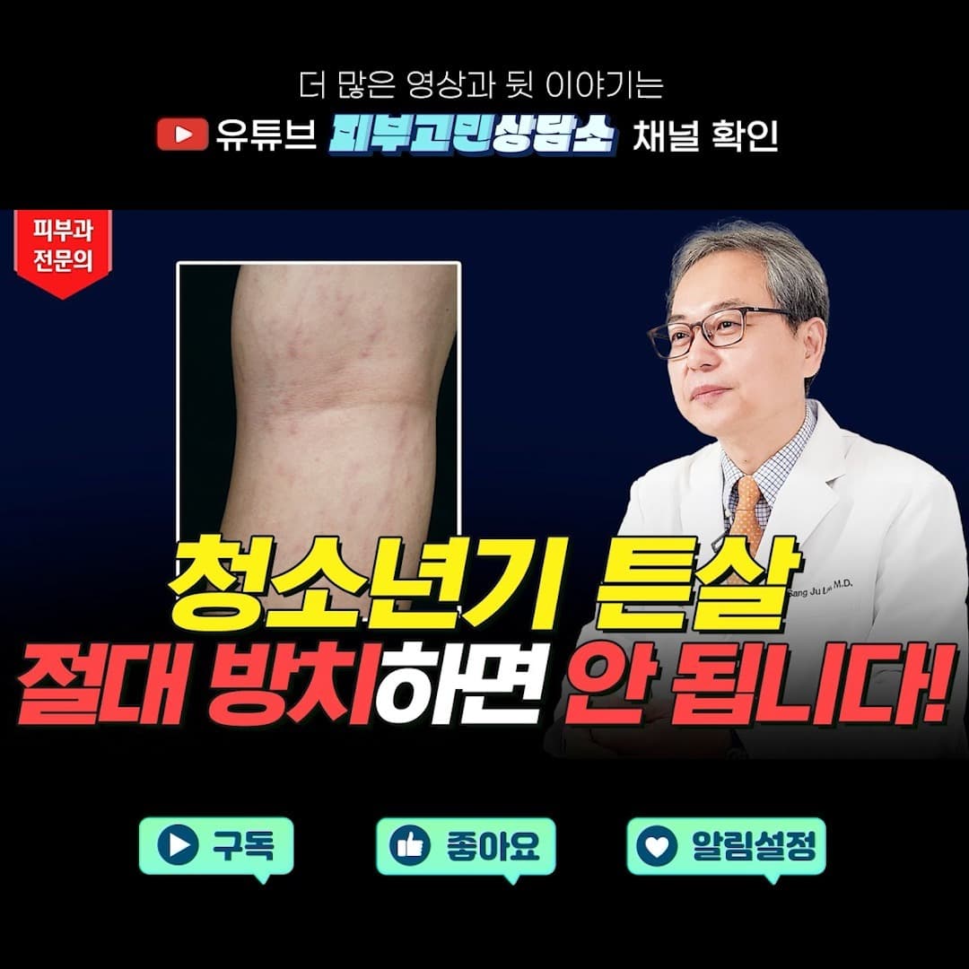 #StretchMarks #StretchMarkLaser