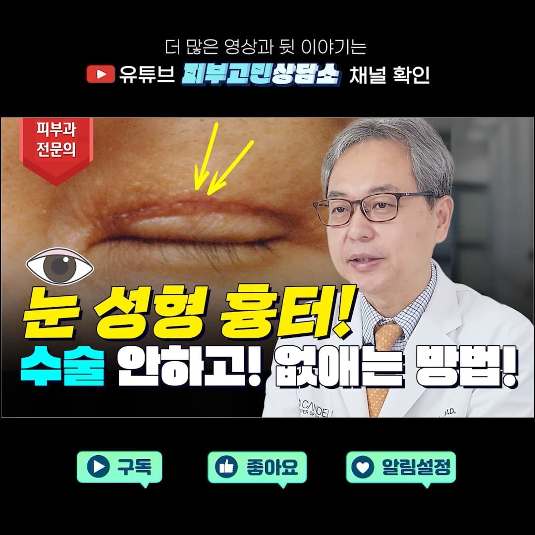 #인기급상승 #쌍꺼풀흉터 #앞트임흉터