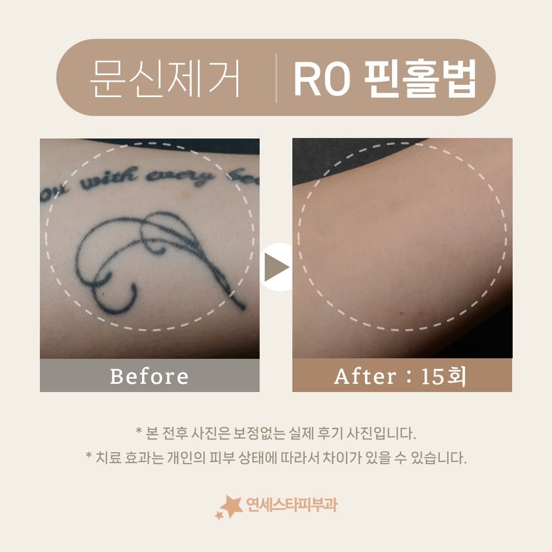 ๐ธ๋ฌธ์ ์ ๊ฑฐ, R0 ํ
ํฌ๋