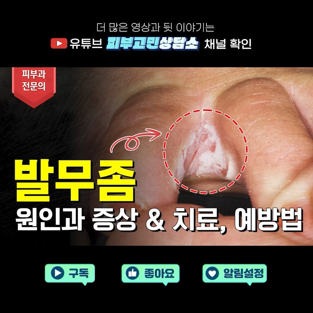지긋지긋한 무좀으로부터