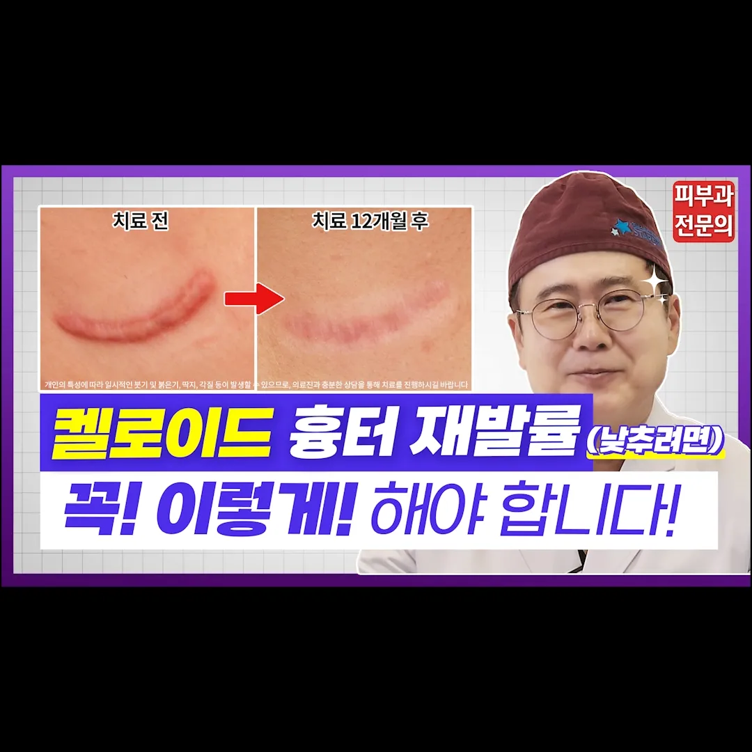 켈로이드 치료를 받고
