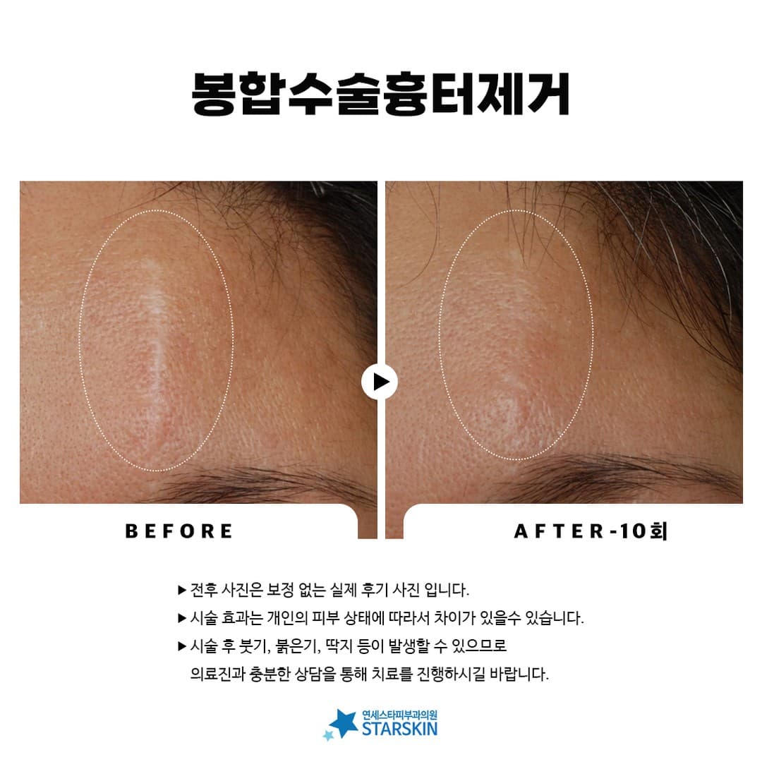 📸 Suture Scar Removal Before & After Photos (2023.07.27)