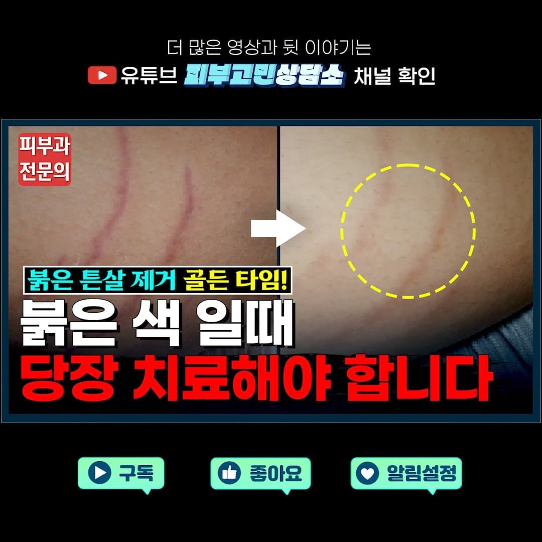 붉은 튼살 ⏱골든타임⏱ 안 놓치려면?