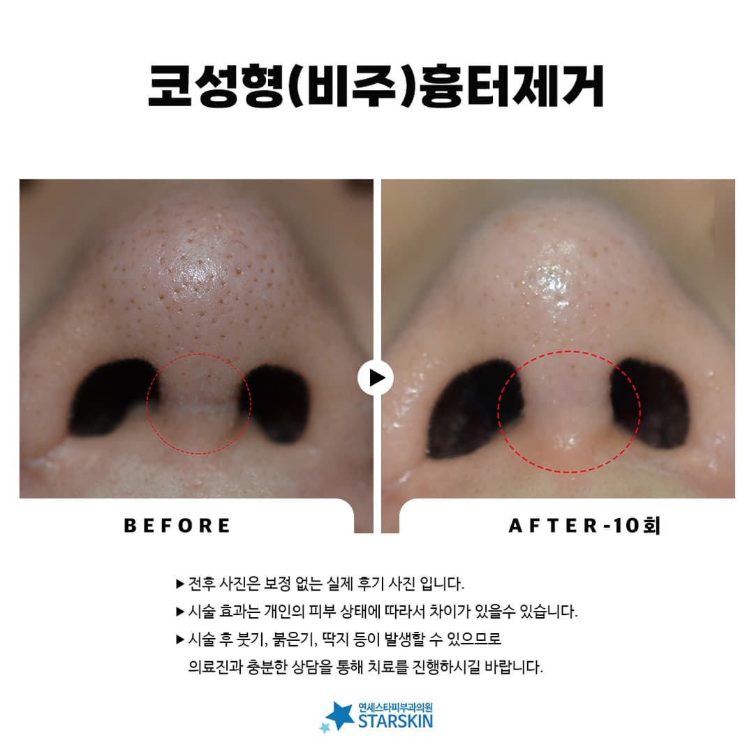 📸 Rhinoplasty Columella Scar Removal Before & After